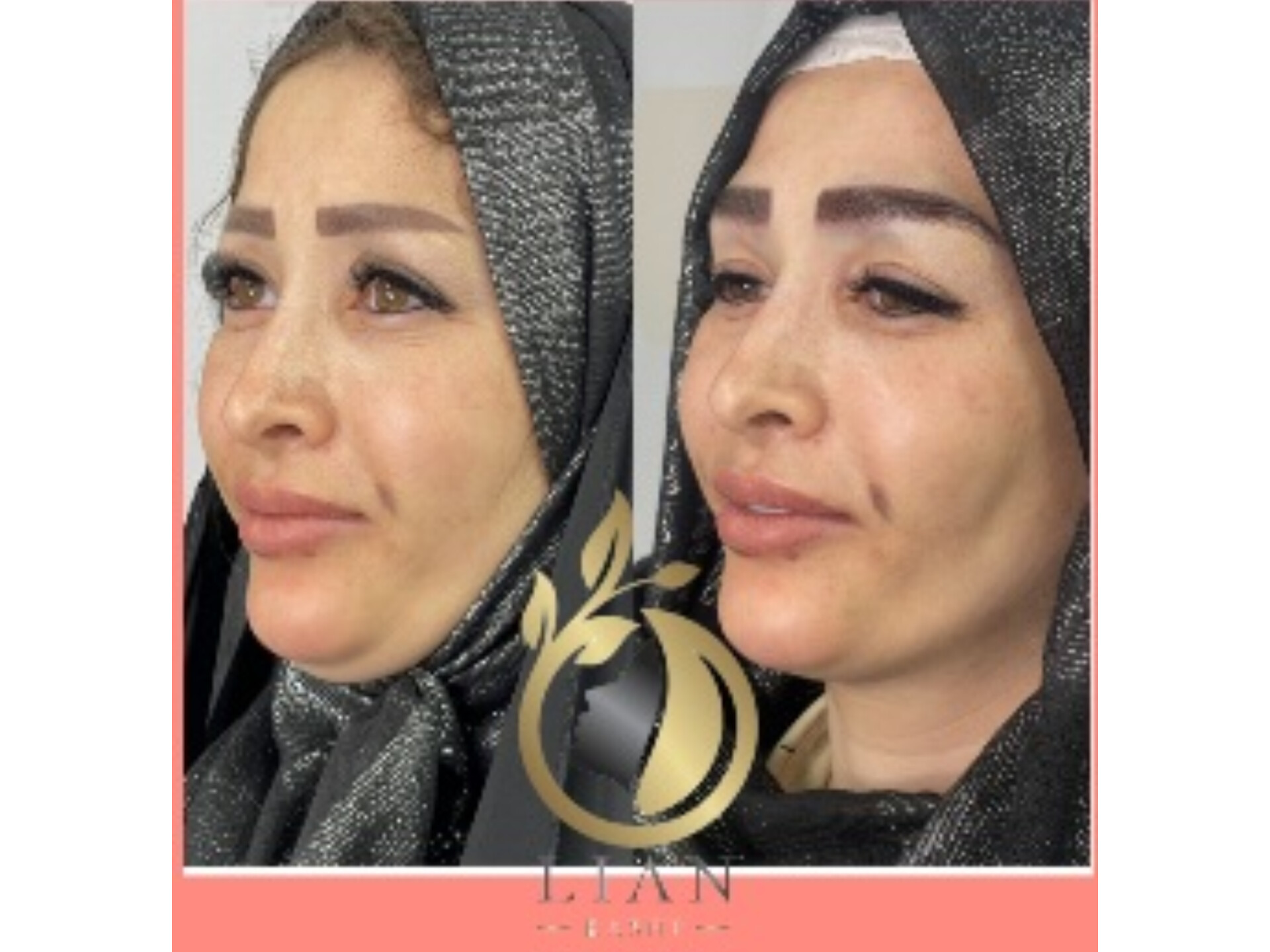 کاشت ابرو