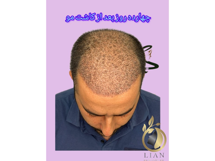 کاشت مو بدون جراحی با روش میکروگرفت
