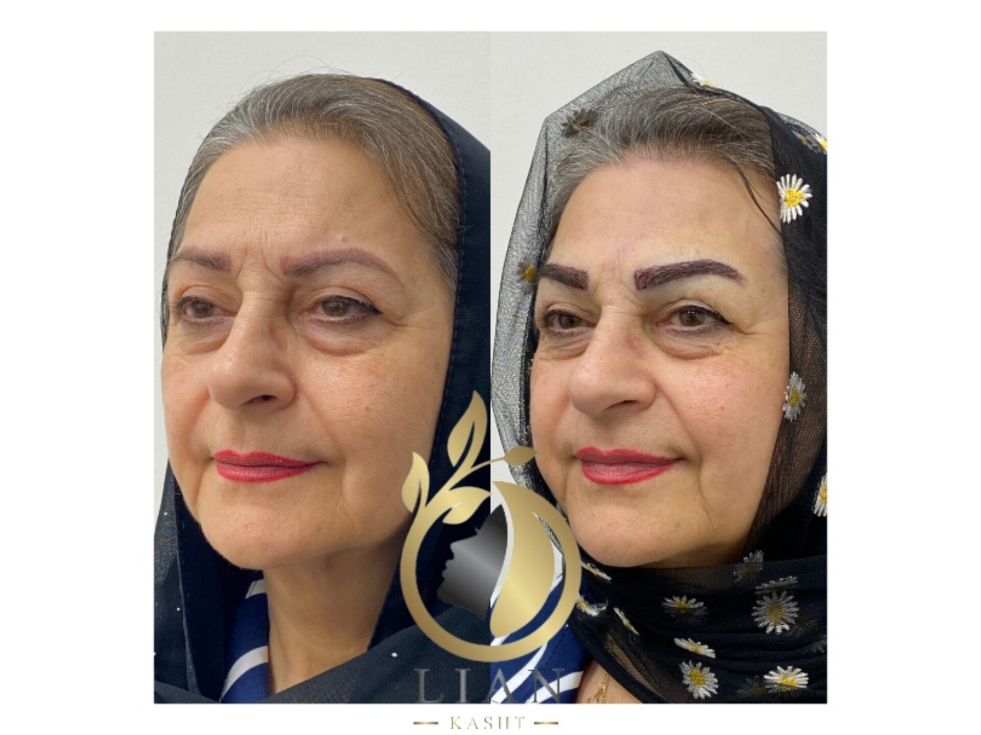 کاشت ابرو به روش میکروگرفت و بدون جراحی