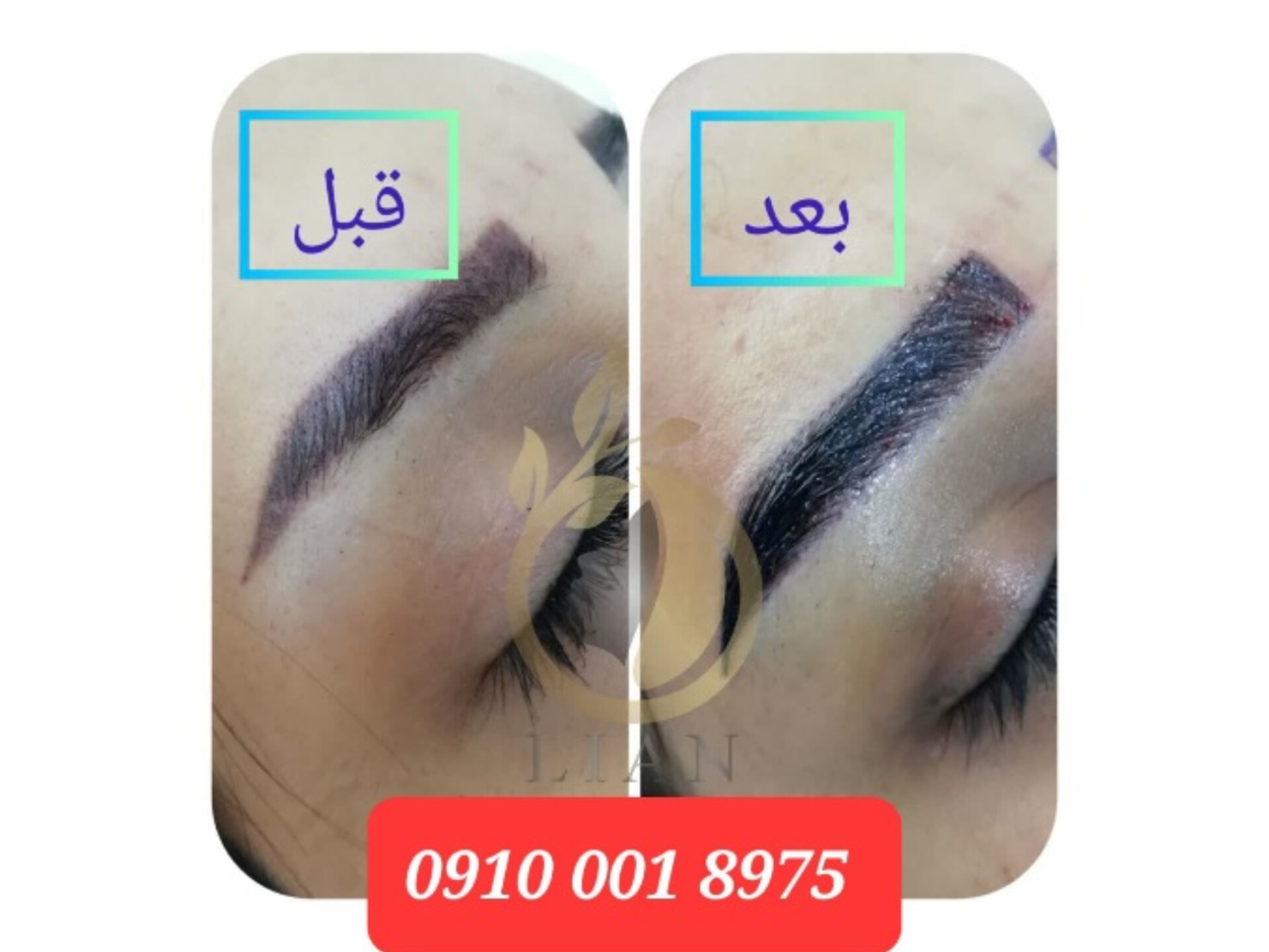 قیمت کاشت ابرو ارزانپر تراکم