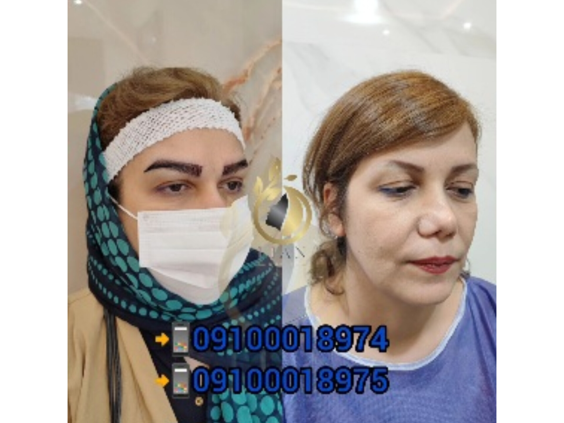 کاشت ابرو بدون حراجی با قیمت مناسب