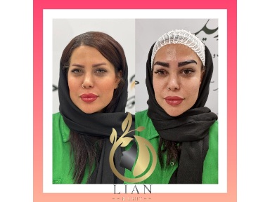 کاشت ابرو در کلینیک لیان