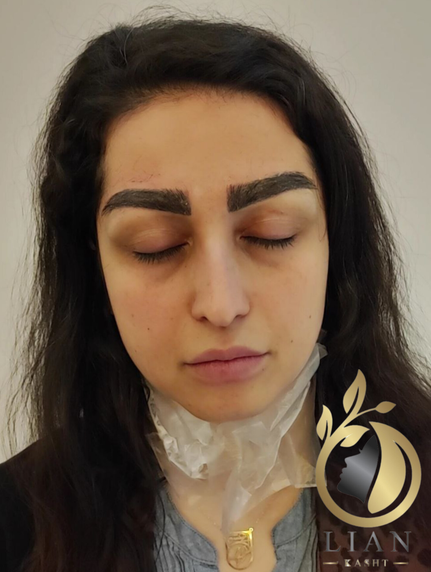 کاشت ابرو و رضایتمندی بعد از یکسال
