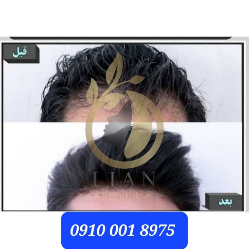 کاشت موی سر با قیمت مناسب و کیفیت بالا