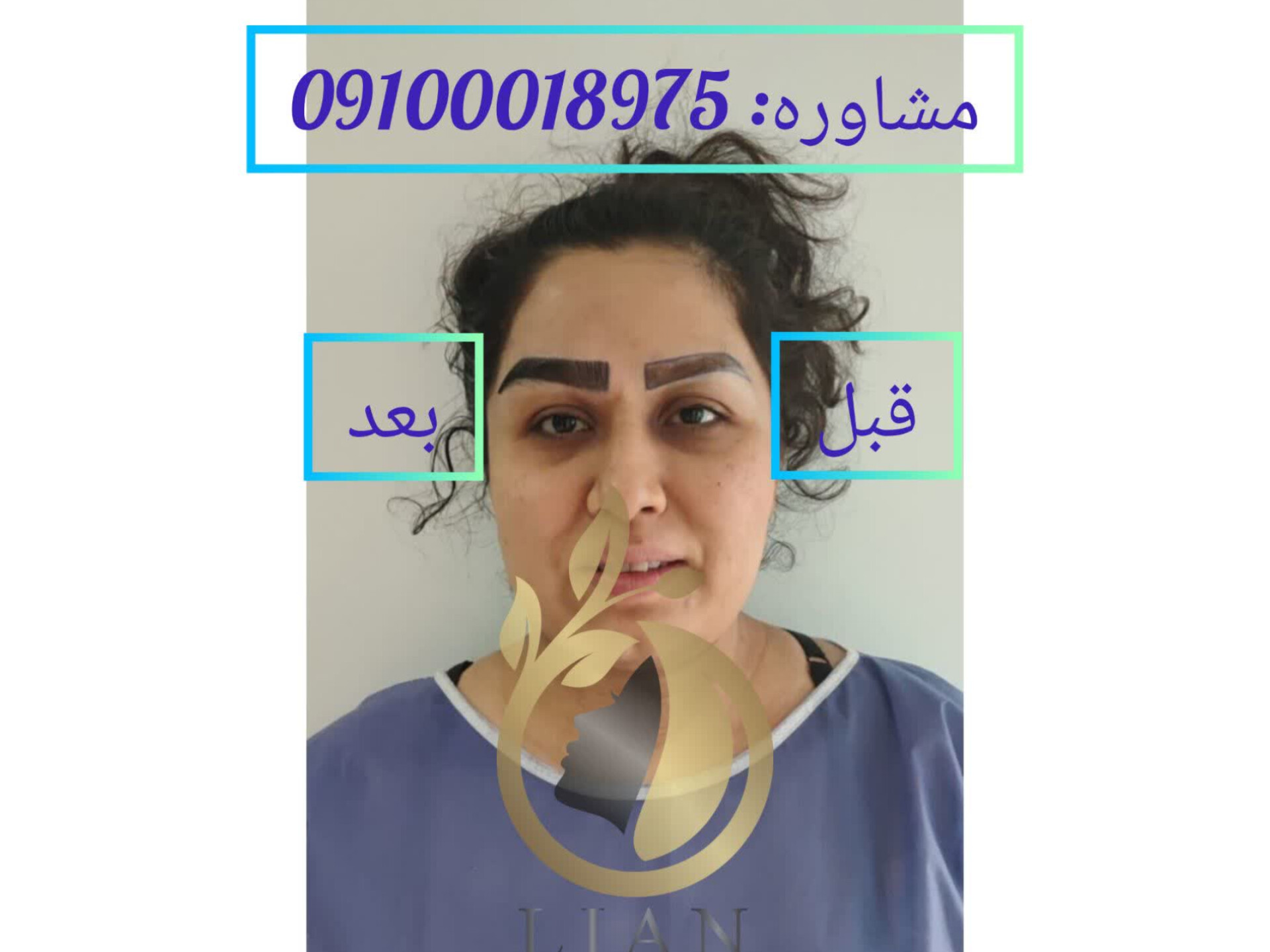 کاشت ابرو بدون جراحی در تهران
